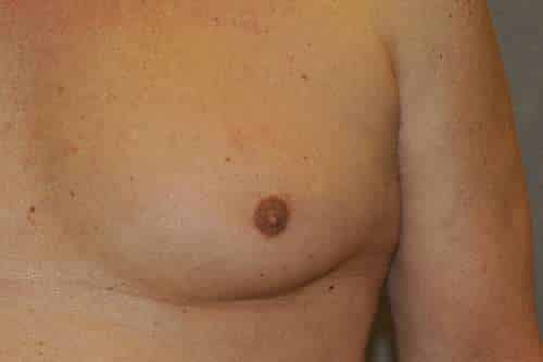Nipple Reduction