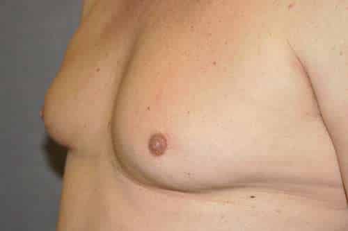 Nipple Reduction