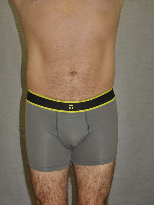 Liposuction Case 5894 After Photo Liposuction