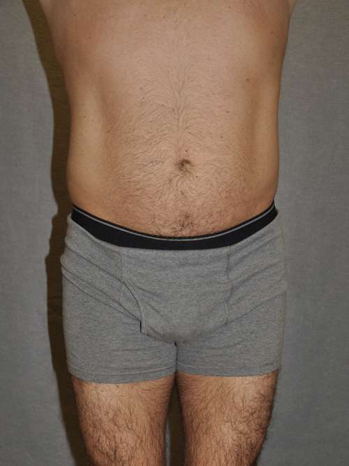 Liposuction Case 5894 Before Photo Liposuction