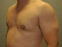 Gynecomastia