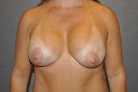 Breast Lift