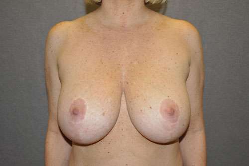 Breast Lift