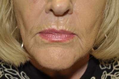 Dermabrasion