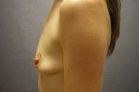 Breast Augmentation