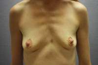 Breast Augmentation