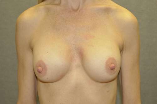 Breast Augmentation Case 5993 After Photo Breast Augmentation