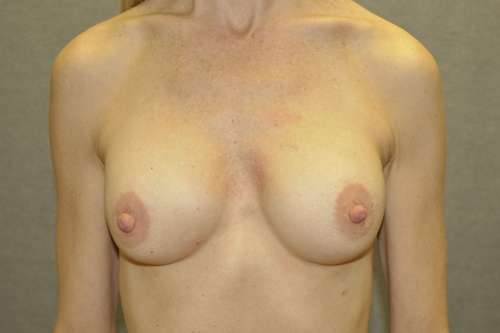 Breast Augmentation