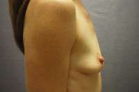 Breast Augmentation