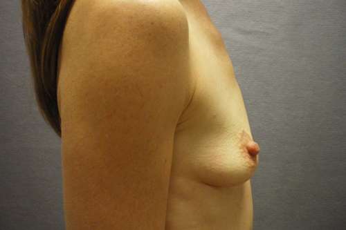 Breast Augmentation