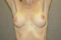 Breast Augmentation