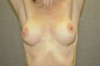 Breast Augmentation