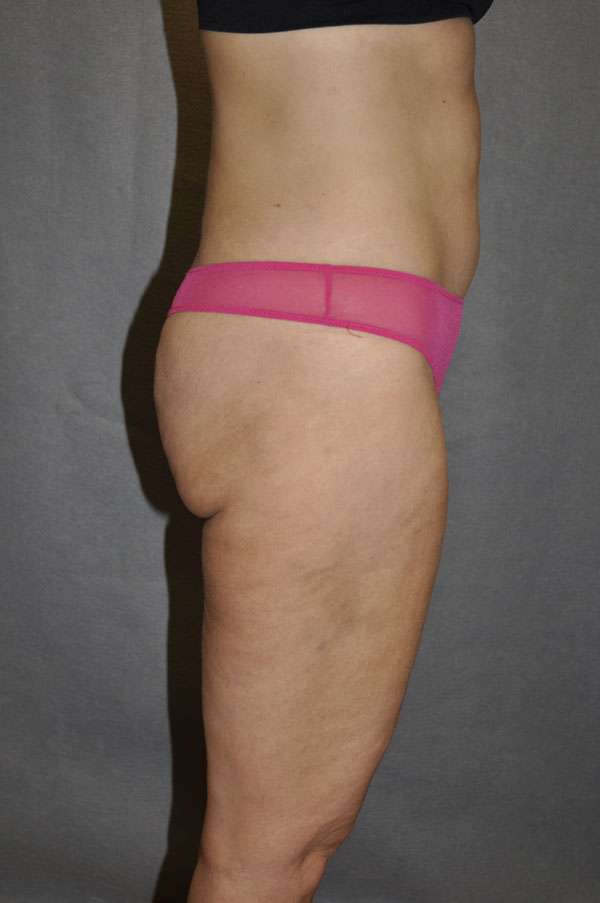 Fat Transfer