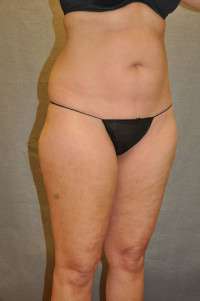 Liposuction