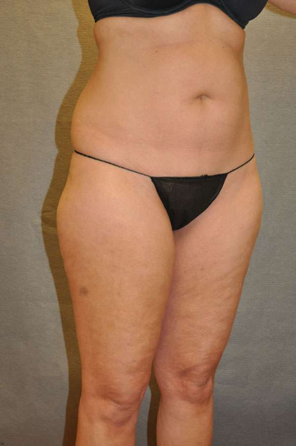 Fat Transfer