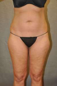 Liposuction