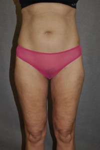 Liposuction