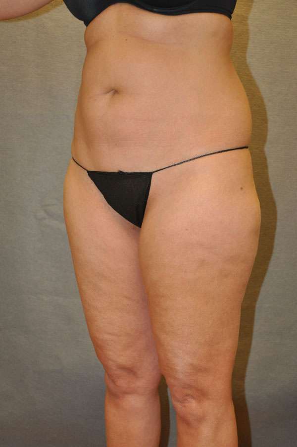 Liposuction