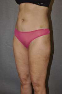 Liposuction