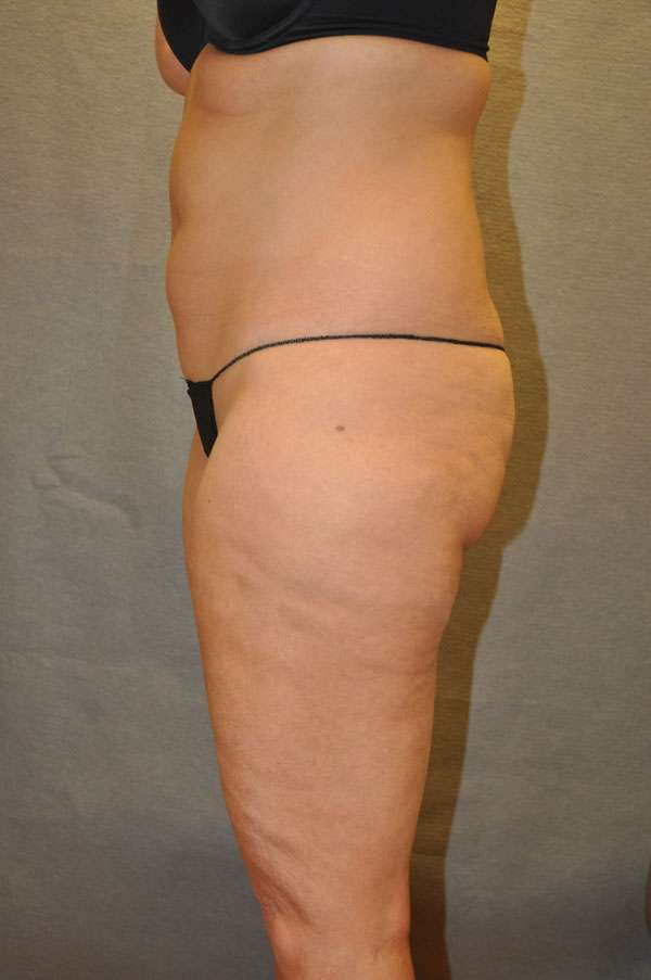 Fat Transfer