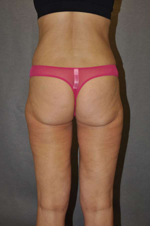 Fat Transfer