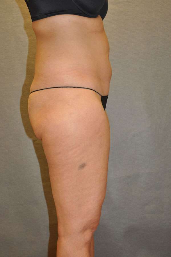 Fat Transfer