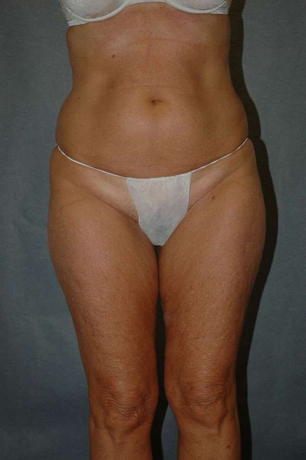 Liposuction Case 6135 Before Photo Liposuction