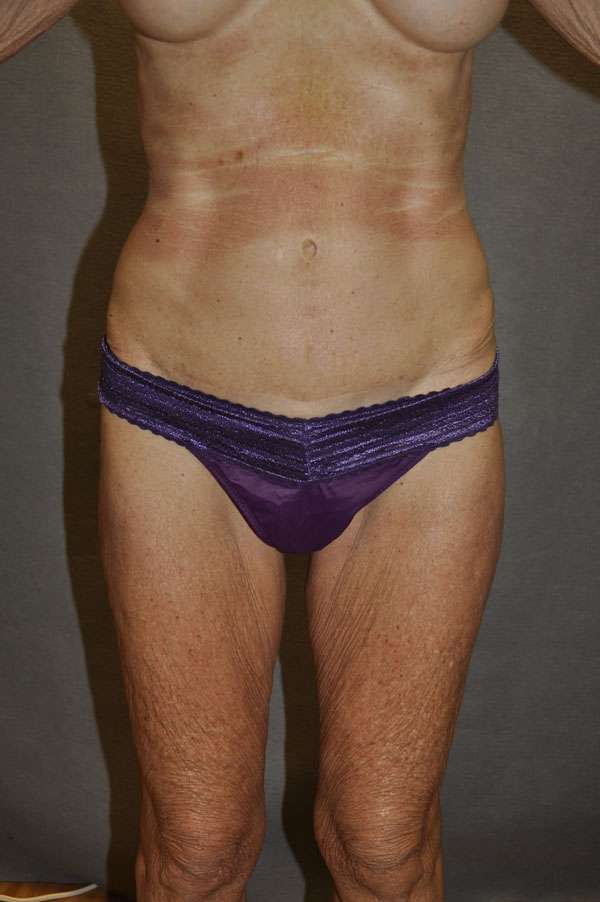 Liposuction Case 6135 After Photo Liposuction