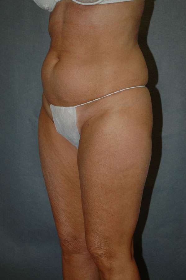 Liposuction