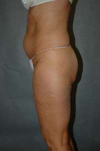 Liposuction