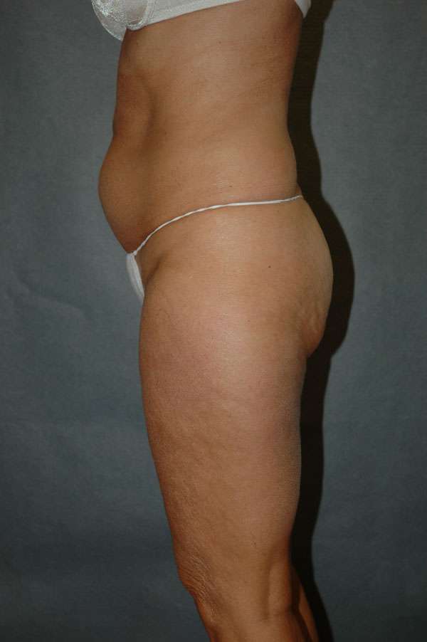 Liposuction