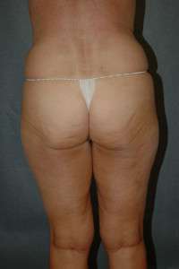 Liposuction