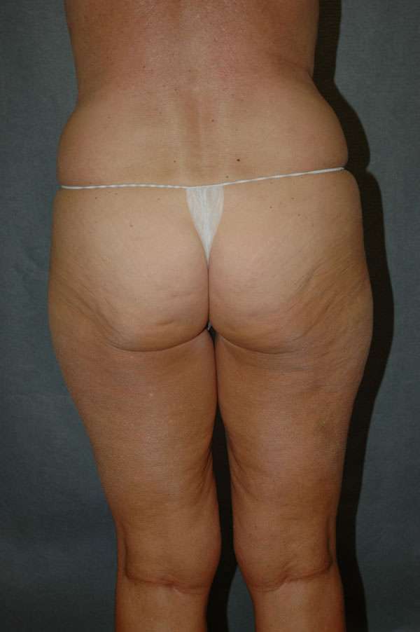 Liposuction