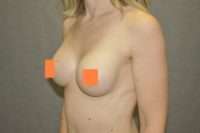 Breast Augmentation