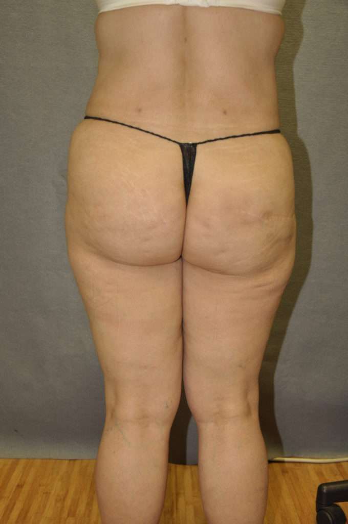 Brazilian Butt Lift Case 6277 After Photo Brazilian Butt Lift
