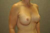 Breast Augmentation with Mastopexy