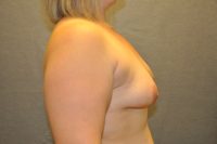 Breast Augmentation with Mastopexy