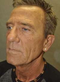 Facelift