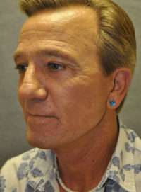 Facelift
