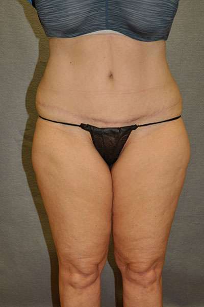 Abdominoplasty