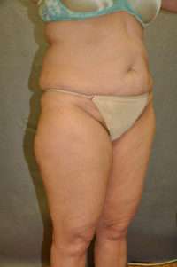 Abdominoplasty