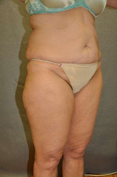 Abdominoplasty