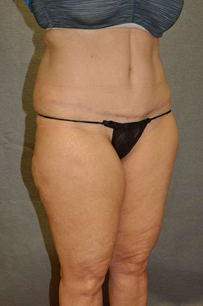 Abdominoplasty