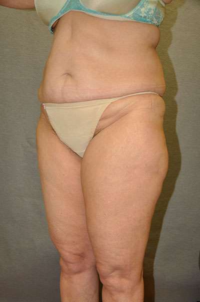 Abdominoplasty