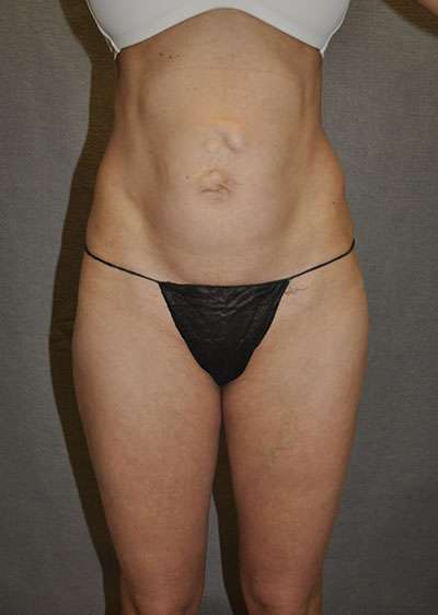 Abdominoplasty Case 6407 Before Photo Abdominoplasty