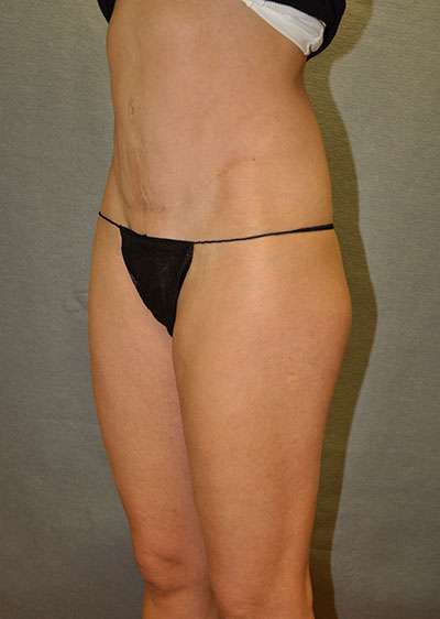 Abdominoplasty