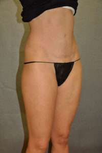 Abdominoplasty