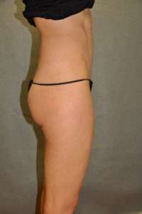 Abdominoplasty