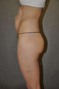 Abdominoplasty