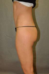 Abdominoplasty